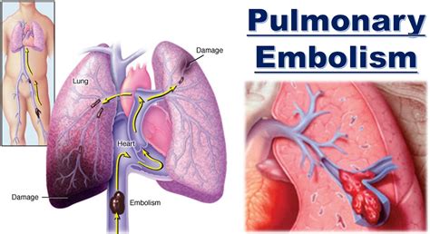 If part of the clot breaks off and. . How long can you have a pulmonary embolism without knowing